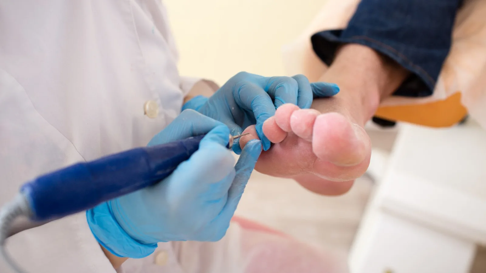Soluciones Expertas para los Hongos en las Uñas en CDMX